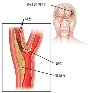 경동맥을 막고 있는 혈전과 혈전에서 떨어져 나오는 색전. 뇌 손상을 보여주는 삽도.