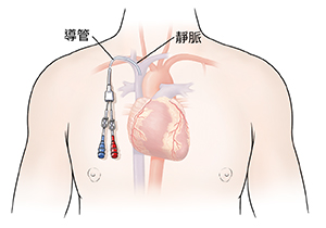 顯示心臟與中央導管的男子胸部輪廓。